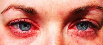 Veracruz, el 5° Estado en el país con casos de conjuntivitis