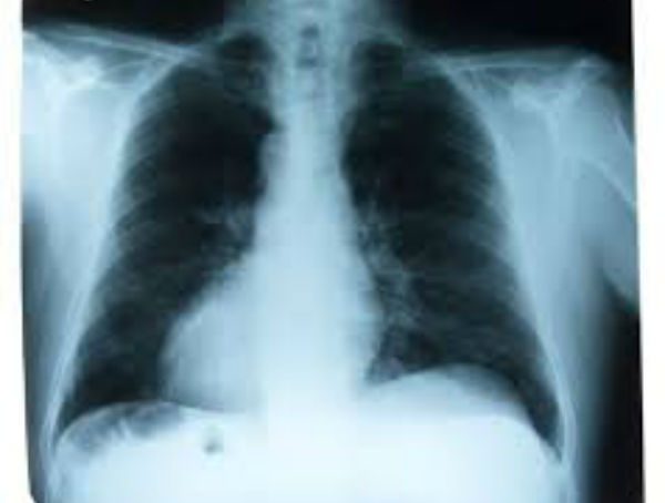 A la alza, los casos de bronquiolitis y bronquitis en la zona centro