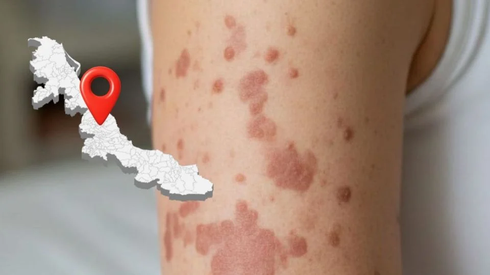 Veracruz, entre los estados más afectados por sarampión; exhortan a vacunarse